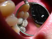 Zahn mit Amalgam-Füllung
